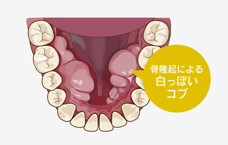 骨隆起による白っぽいコブ
